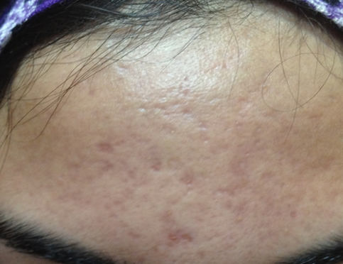 Acne After Treatment